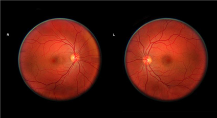 Retinal Shift