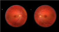 Retinal Shift